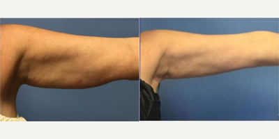 Woman treated with CoolSculpting - Woman treated with CoolSculpting.