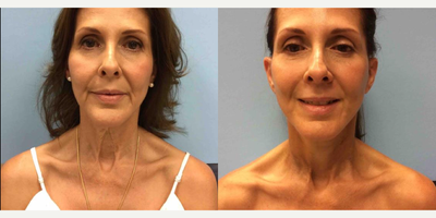 45-54 year old woman treated with Facelift - Patient 3 days after a full face and neck lift. Quick recovery with excellent results .&nbsp;