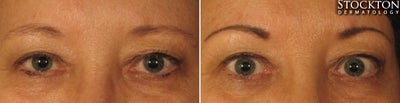 55-64 year old woman treated with Permanent Makeup - Permanent makeup is a cosmetic procedure that uses tattoos as a way of producing designs that looks like a person has makeup on. Not only does this procedure work for those who want to look their best all the time, this is also recommended for those who have lost, for example, their eyebrows due to medical conditions such as chemotherapy, alopecia, and genetic anomalies.