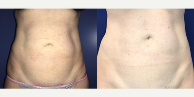 Woman treated with Liposuction - Woman treated with Liposuction