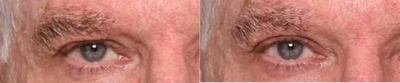 Plasma Pen - Woman treated with Plasma Pen