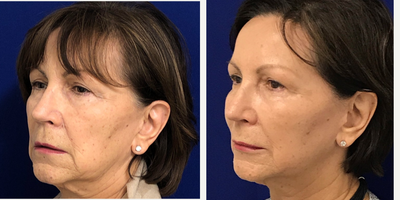 65-74 year old woman treated with Restylane - Liquid Facelift on my 70 years young patient. I used Restylane classic to plump her lips, Restylane Defyne in the nasolabial folds & marionette lines to soften & reduce the deep creases, Restylane Lyft in her cheeks to restore facial volume & to also lift the lower part of the face (jawline) and last but not least Dysport to address fine lines. 2 weeks post treatment, she is extremely happy with her rejuvenated appearance!