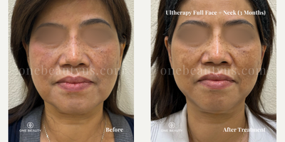 45-54 year old woman treated with Ultherapy - An early 50s woman underwent Ultherapy, achieving significant skin tightening, reduced sagging, a firmer double chin, a more defined jawline, and an overall lifted appearance. Post 3 months result.
