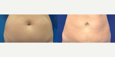 Woman treated with Liposuction - Woman treated with Liposuction