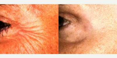 Patient treated with Botox - Patient treated with Botox