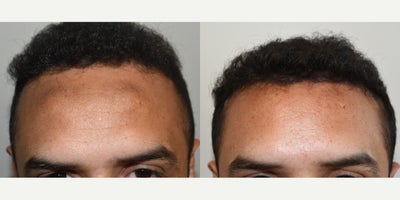 45-54 year old man treated with Forehead Reduction - Result/ before and after hairline lowering/forehead reduction surgery with frontal bone rasping. 48yo male with prominent forehead bone and high hairline who underwent surgery that corrected both concerns.