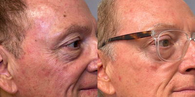65-74 year old man treated with Lumecca, IPL - Lumecca IPL effectively targets and diminishes sun damage with its powerful intense pulsed light (IPL) technology, significantly improving skin tone and texture. After just one treatment, notable results can be seen within two weeks, revealing a clearer and more rejuvenated complexion.