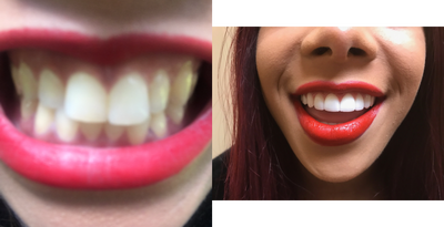 22 year old woman treated with 8 Porcelain Veneers for bunny teeth - Patient complained of bunny teeth. This was how she described her two front teeth on the top. Her bunny teeth made her self-conscious about smiling or expressing herself fully in public settings. So, this patient decided to get 8 veneers done by Dr. Thompson. Two visits later, she has perfectly straight, permanently white teeth and&nbsp;no bunny teeth.