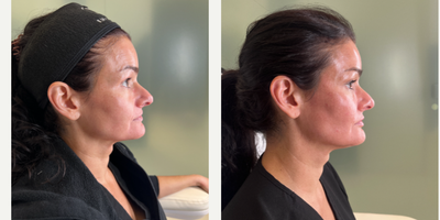 FILLER 'N THREADS COMBO - Our patient works in the industry so she would like to look her absolute best. She has noticed some signs of aging on her face, such as loss of volume in her mid face and prominent nasolabial folds. To correct this, we sculpted her face with filler as well as used threads- to give her a complete facial rejuvenation. We were able to define and sculpt her mid face leaving her cheeks contoured. We also gave her lips some natural looking plumpness, her chin that desired heart shaped look, and we didn't forget about defining her jaw for a snatched neck. All in all, she cannot believe how amazing she looks and is in love with her results!
