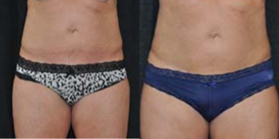45-54 year old woman treated with truSculpt - Treatment areas: abdomen, waist, inner thighsNumber of treatments: 153 years old, 5'8 tall, 166 lbFat pinch thickness: each area decreased at least 25% after treatment