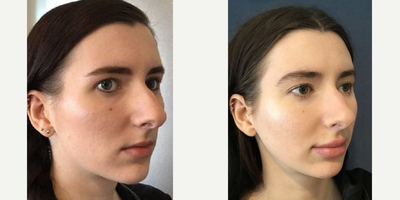 25-34 year old woman treated with Lip Fillers - Patient treated for volume to lips