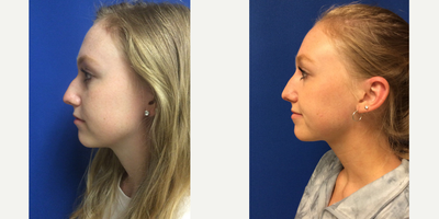 25-34 year old woman treated with Nonsurgical Nose Job - Nonsurgical Nose Job