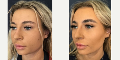 18-24 year old woman treated with Lip Fillers - 18-24 year old woman treated with Lip Fillers