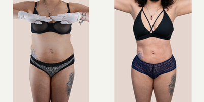 25-34 year old woman treated with Brazilian Butt Lift - This patient underwent 360Lipo with BBL. She is shown 3 months post-op after receiving 900 cc of fat to each buttock and 200 cc into each hip dip.