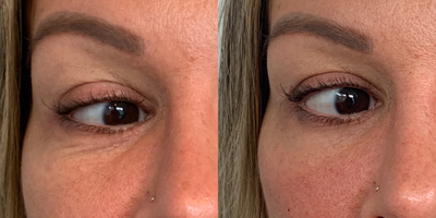 35-44 year old woman treated with Injectable Fillers - Tear trough filler done with Juvederm