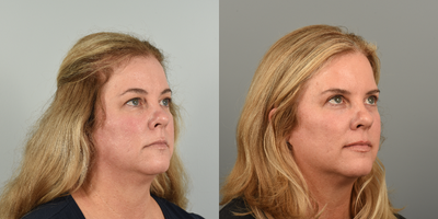 45-54 year old woman treated with Eyelid Surgery, CO2 Laser - This patient had the following procedures: upper blepharoplasty, lower lid pinch, and periorbital fractional CO2 laser. After photos are 3 months post op.