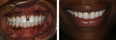 Invisalign to Close Gap - Patient came to Dr. Broome with a large gap in between her front teeth. Through Invisalign treatment, the gap was closed.