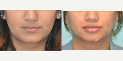 25-34 year old woman treated with Lip Implants - Patient underwent permalip implant procedure to improve volume and projection in her lips.