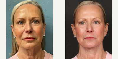 65-74 year old woman treated with Deep Plane Facelift, Laser Resurfacing, Facial Fat Transfer - 68 year old deep plane face lift, fat grafting and laser resurfacing