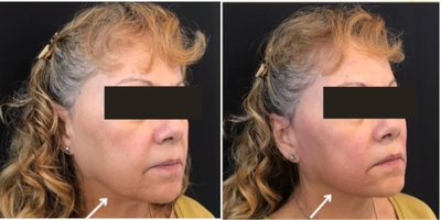 45-54 year old woman treated with Thread Lift - Thread lift treatment by Dr. Deborah Marciano