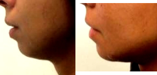 35-44 year old woman treated with Chin fat agumentation - This woman had chin augmentation with fat transfer. This is immediate so the results are partially due to edema and swelling but it gives a good idea of the results that could be obtained.