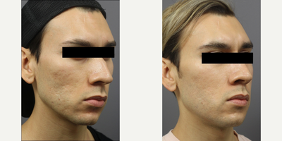25-34 year old man treated with Acne Scars Treatment - Acne Scar Subcision