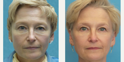 54 year old woman treated with Sculptra Aesthetic and Pelleve - This patient was treated with Sculptra and full face Pelleve.