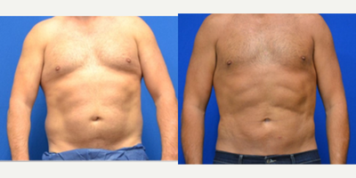45-54 year old man treated with Liposuction, Abdominal Etching, Umbilical Hernia Repair - Liposuction areas: chest, upper abdomen, lower abdomen, full waist