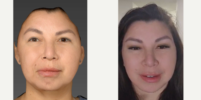 35-44 year old woman treated with Facelift, Facial Reconstructive Surgery, Neck Lift, Brow Lift - deep plane facelift, brow lift buccal fat pad removal canthopexy