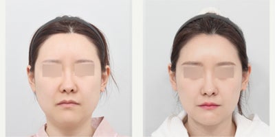 35-44 year old woman treated with Jaw Reduction, Cheekbone Reduction, Chin Liposuction, AccuLift - She had mandible jaw reduction, cheekbone reduction, genioplasty, chin liposuction and thread lifting for the neck