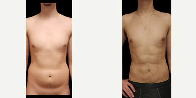 25-34 year old man treated with Abdominal Etching, Liposuction, Liposculpture, SAFELipo, Vaser Liposuction, Tumescent Liposuctio - Natural results