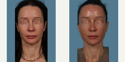 35-44 year old woman treated with Sculptra - Our 44 year old patient was so happy with her Sculptra results that she has decided to share her journey with you. She was bothered by facial volume loss and sagging skin and has been getting Morpheous treatments without much result. She had two concerns. One looking overfilled. Second concern was that she heard that getting biostimulants like Sculptra and Radiesse can preclude you from getting a facelift down the road as it can create scar tissue. In regards to looking overfilled, I shared my approach, which is to restore volume in the outer part of the face where the line of ligaments live. Restoring volume in the outer part of the face allows for the mobile more midline and saggy portion to be lifted upward lifting her natural fat pads to where they used to live, much like is accomplished with a deep plane facelift. I also reassured her that I have not had issues performing my deep plane face lifts after Sculptra treatments. Histologic studies show that these bio-stimulants produce collagen and elastin, not scar tissue when performed properly as in my technique. In general, I am also not injecting bio-stimulants in the mobile portion of the face where the deep plane portion of the facelift is performed as it doesnt result in any facial lifting.