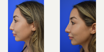 25-34 year old woman treated with Rhinoplasty, Restylane - This patient had a chemical rhinoplasty using Restylane. You can see the difference immediately with no down time!!
