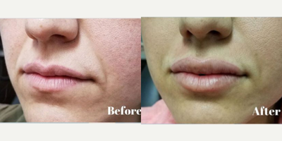 35-44 year old woman treated with Injectable Fillers - The patient had 1cc of Juvederm Ultra in the upper and lower lip for beautiful and natural results.
