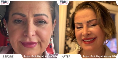 45-54 year old woman treated with Deep Plane Facelift, Facelift, Facial Fat Transfer, Eyelid Surgery, Neck Lift - 45-54 year old woman treated with Deep Plane Facelift, Facelift, Facial Fat Transfer, Eyelid Surgery, Neck Lift