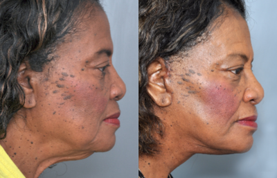 65-74 year old woman treated with Facelift - This patient had a Facelift to help tighten sagging muscles and skin in her cheeks for a more natural looking rejuvenation.