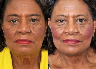 65-74 year old woman treated with Facelift - This patient had a Facelift to help tighten sagging muscles and skin in her cheeks for a more natural looking rejuvenation.