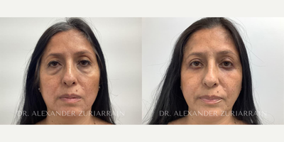 55-64 year old woman treated with Eyelid Surgery - 55-64 year old woman treated with Eyelid Surgery- 1 month post-op