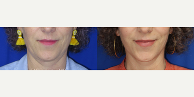Woman treated with Mini Facelift - Mini Lift results on our beautiful patient who is just 6 weeks post-op and beautifully recovered. This procedure helped to tighten and contour her lower face and jawline.