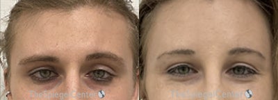 25-34 year old transgender woman treated with Forehead Reduction - 25-34 year old transgender woman treated with Forehead Reduction