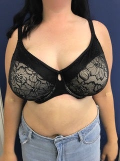 24 Y/o Reduction 32i to a 32 D/dd? - Review - RealSelf