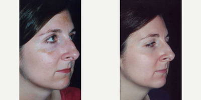 MegaPeel Microdermabrasion - MegaPeel Microdermabrasion