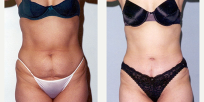 37 year old woman treated with Tummy Tuck - 37 year old woman treated with Tummy Tuck as well as Tumescent Liposuction