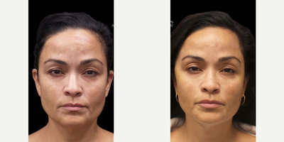 Woman treated with Silhouette InstaLift, Nonsurgical Facelift - Woman treated with Silhouette InstaLift, Nonsurgical Facelift