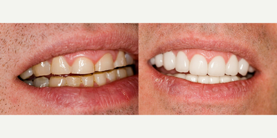 45-54 year old man treated with Dental Crown - This patient had severe wear requiring crowns on all of his teeth.