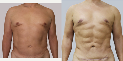 45-55 year old man treated with Male Tummy Tuck - 45-55 year old man treated with Male Tummy Tuck, shown 6 months post op.