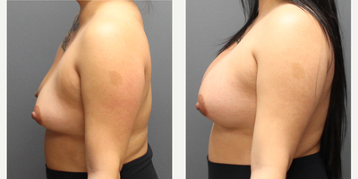 Breast Augmentation with Natrelle Breast Implants for this 33-year-old Woman - This 33-year-old female had breast augmentation with Natrelle Inspira (SRF-450) implants. She is 2 months recovered.