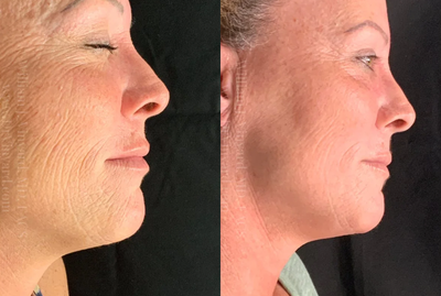 45-54 year old woman treated with CoolPeel - 45-54 year old woman treated with CoolPeel
