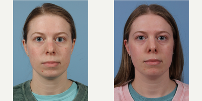 18-24 year old woman treated with Isolaz - A 24 year old came to the office of Dr. Suzanne Yee to discuss acne.  The patient was treated with Isolaz and is very pleased with her results.