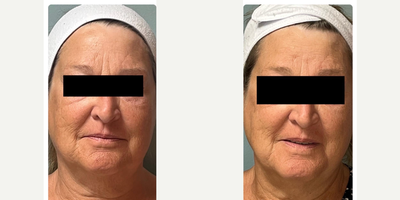 65-74 year old woman treated with Opus Plasma - Client wanted to decrease the appearance of her facial lines and enlarged pores. After only one Opus Plasma she has seen a noticeable improvement, Typically 3 treatments that are anywhere from 3-4 weeks apart is recommended in order to achieve the best results.